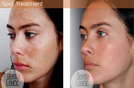 Voorbijganger groot Verplicht Medische peeling voor minder acne, littekens en pigment